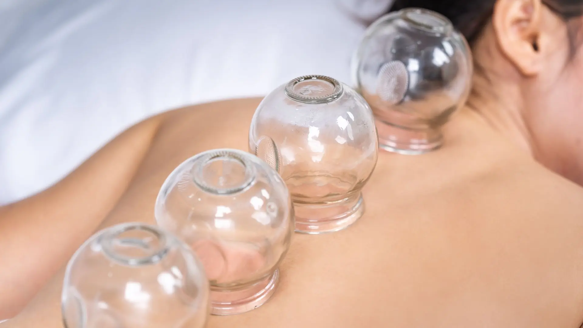 Circulatory issues and inflammation Cupping cups improving blood flow and reducing inflammation