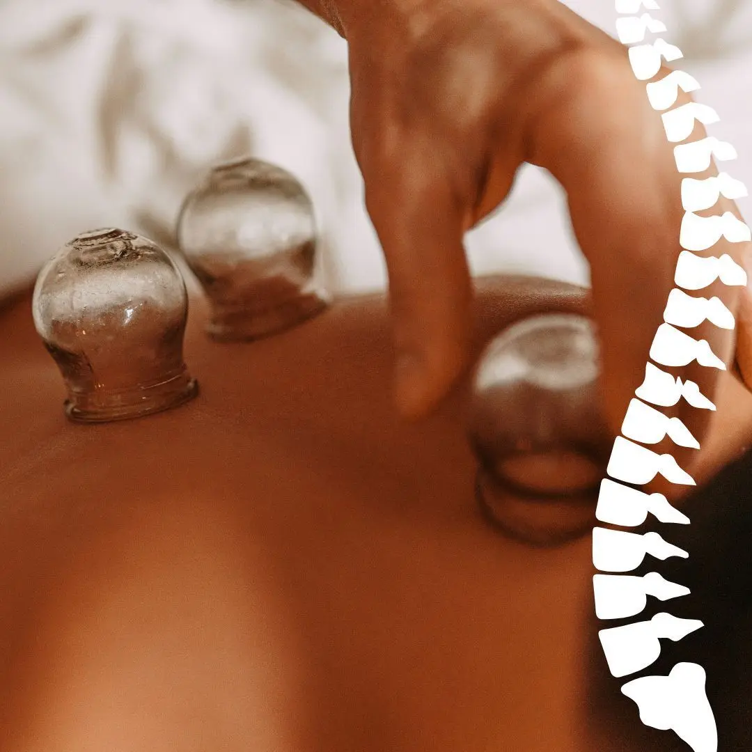 Cupping Therapy in Washington PA – What You Need to Know Patient receiving cupping therapy in Washington PA to relieve muscle tension